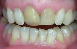 потемнение переднего зуба