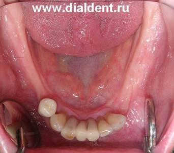 вид нижних зубов до лечения