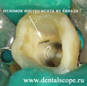 отломок инструмента из канала зуба