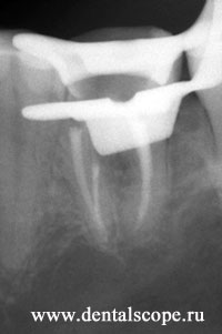 пломбирование каналов зуба