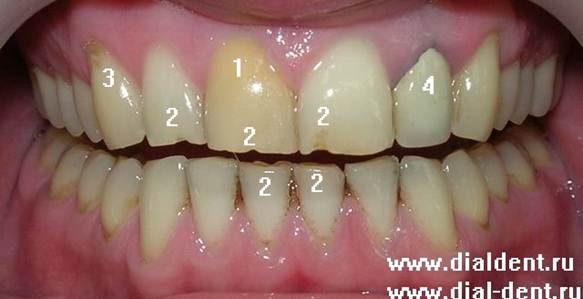 эстетические проблемы передних зубов
