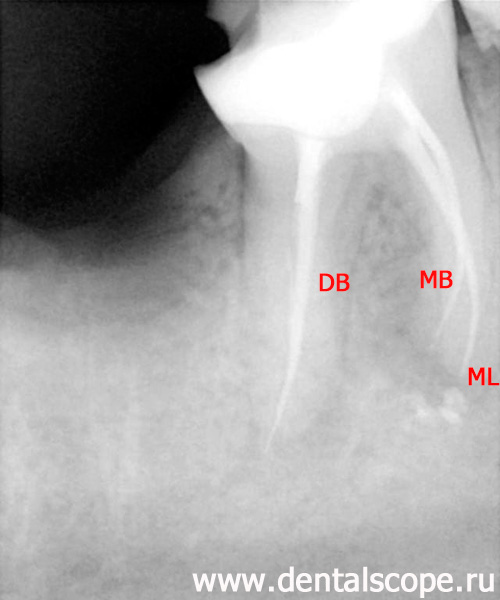 рентген зуба до перелечивания каналов