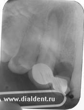 рентген кисты зуба