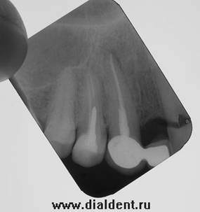 лечение кисты зуба