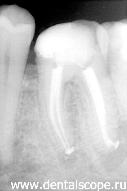 пломбирование каналов зуба