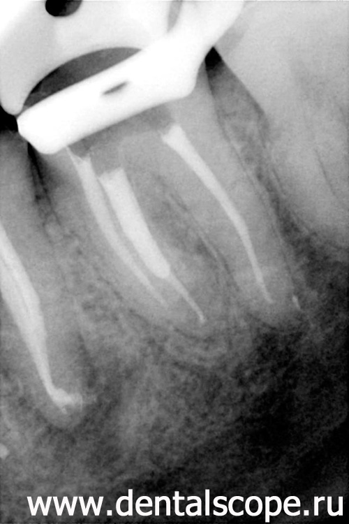 обработка и временное пломбирование каналов зуба