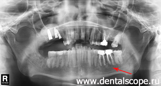 панорамный снимок зубов после лечения кисты зуба
