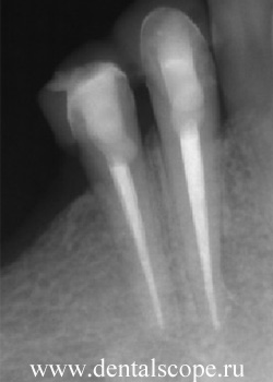 нехирургическое лечение кисты зуба