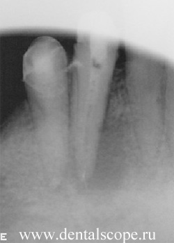 киста зуба лечение