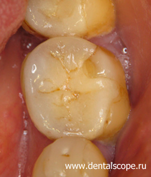 фото проблемного зуба