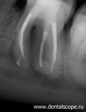 пломбирование каналов зубов