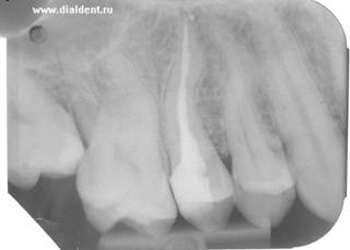 рентген зуба спустя два года