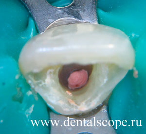 лечение каналов потемневшего зуба