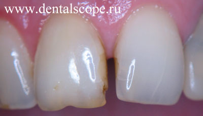 лечение зуба изменившего цвет