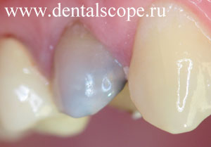 резорцин-формалиновая окраска зуба