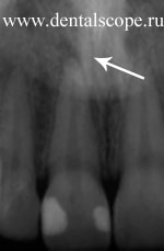 рентген потемневшего зуба