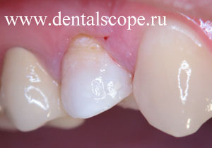 восстановление цвета резорцин-формалинового зуба