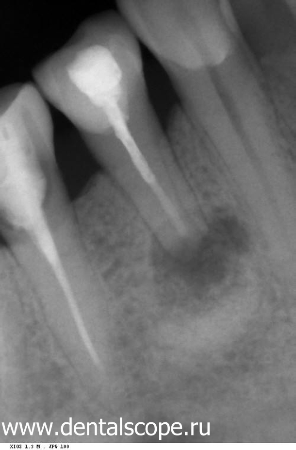 периодонтит, резекция верхушки корня зуба