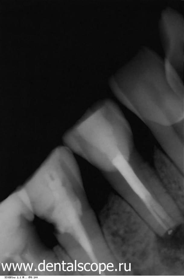 пломбировка корневых каналов зуба