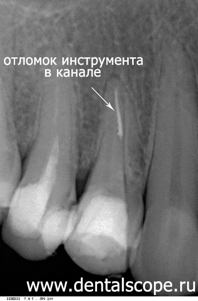 отломок инструмента в канале зуба