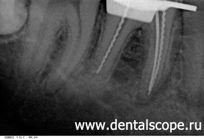 распломбировка каналов зуба с микроскопом
