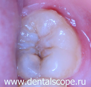 кариес при диагностировании - пятно на зубе