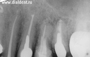 рентген после лечения каналов зуба